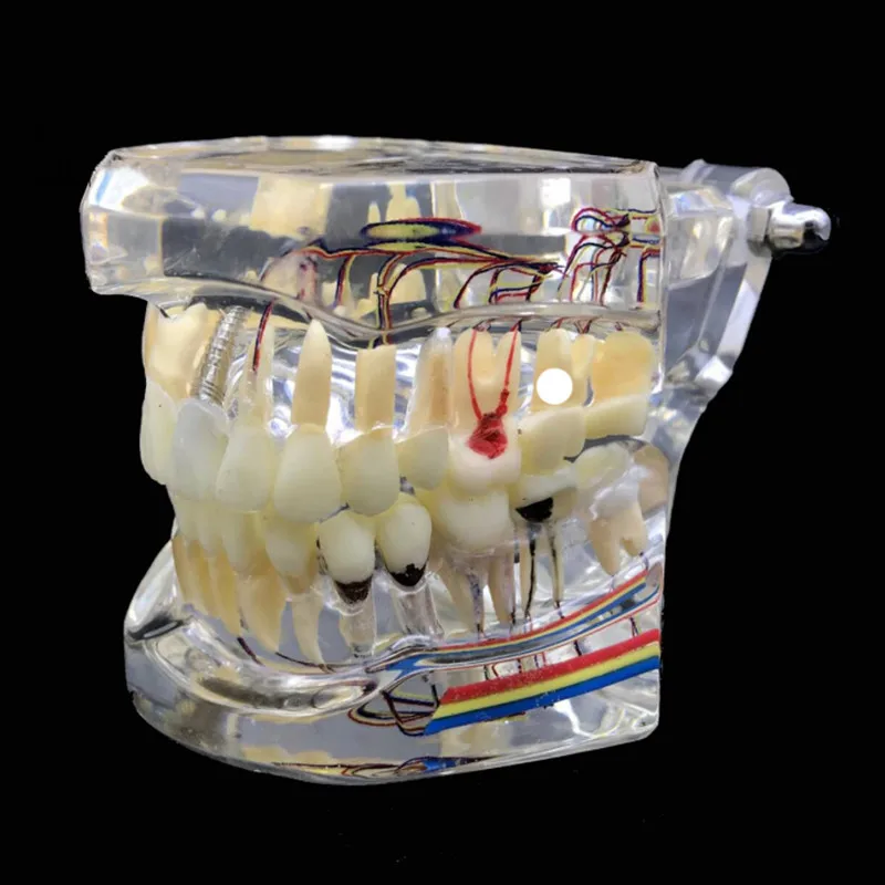Стоматологическая реставрация зубов Модель с зубным нервом отсоединяемые зубы