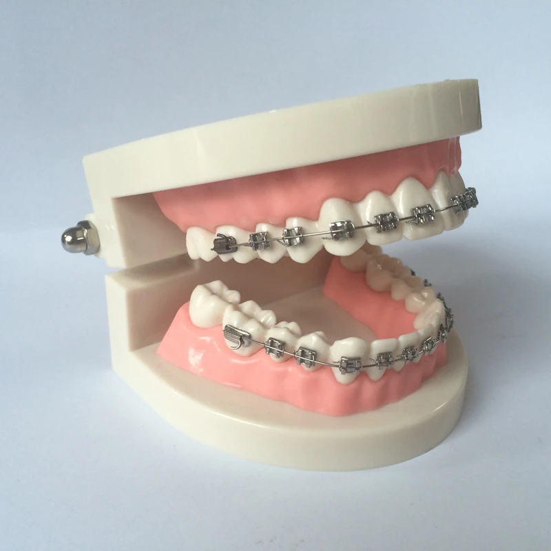 Стоматологическая Ортодонтическая модель с кронштейнами | Красота и здоровье