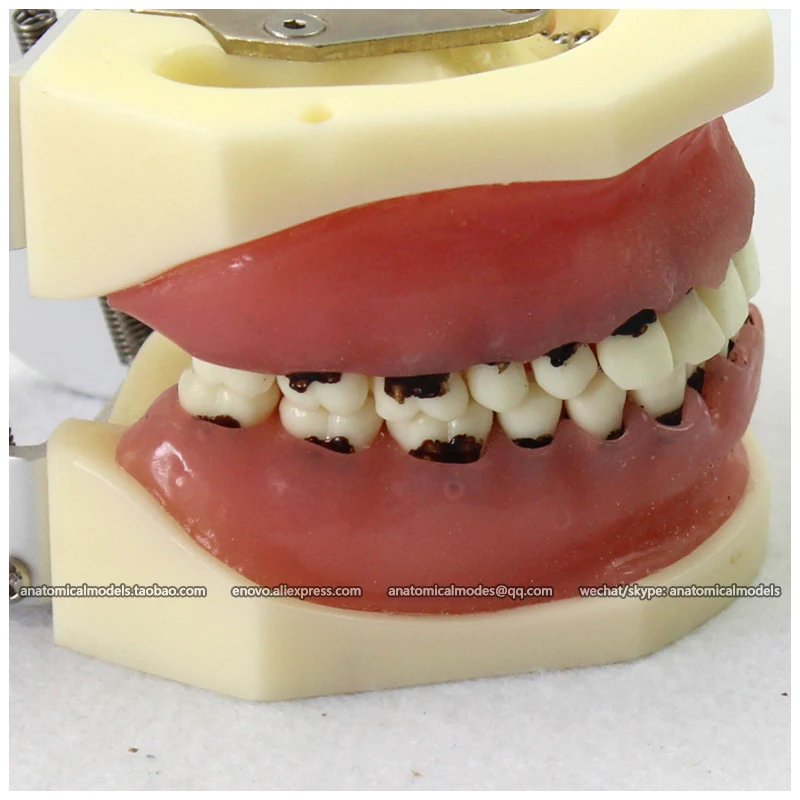 CMAM-22304 Серьезные Заболевания Пародонта Щековая Модель Хирургии Обучение |