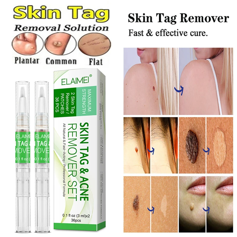 2 шт. средство для удаления бородавок и | Красота здоровье