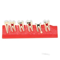 1pcs dental caries model illustration model 4011 for medical teaching model