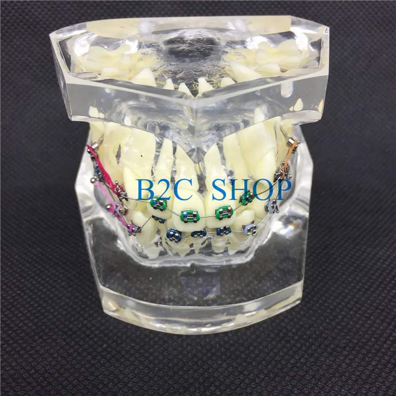 Стоматологическая Ортодонтическая модель с красочными кронштейнами для