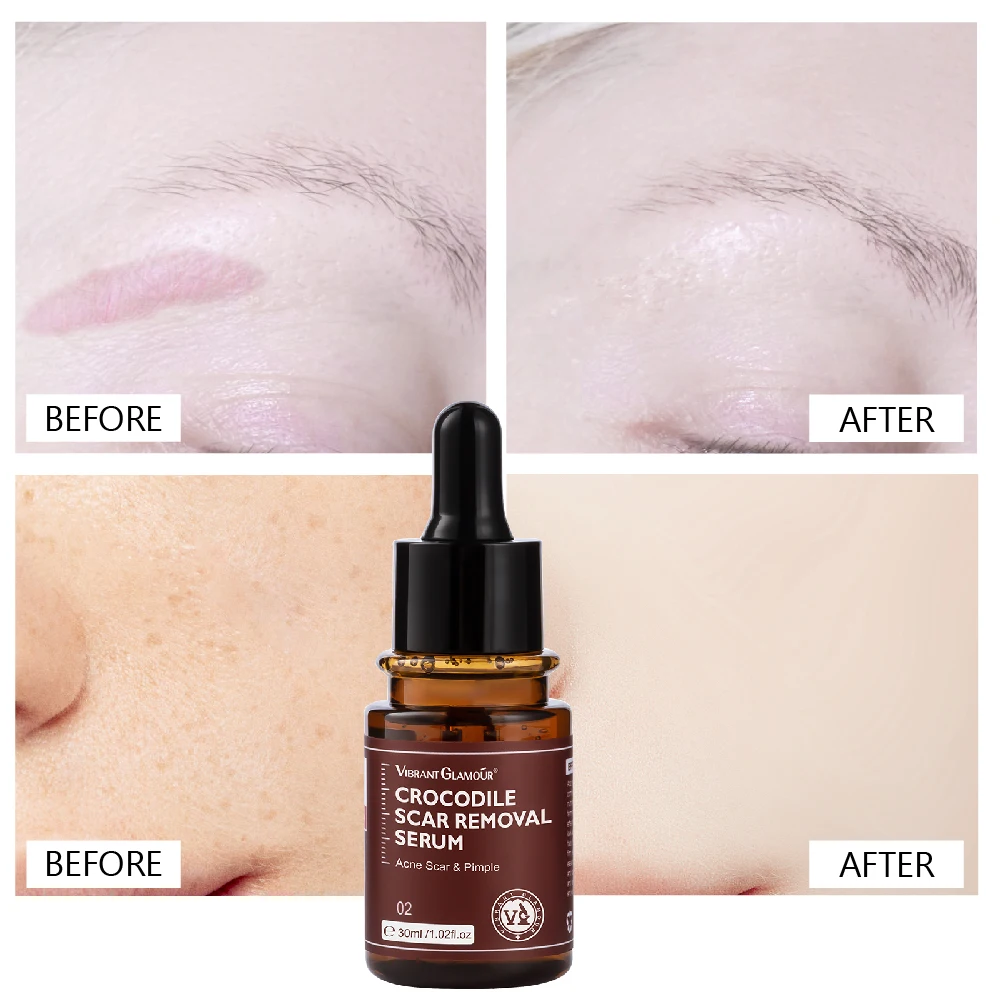 Восстанавливающая Сыворотка для крокодиловых шрамов лечение акне растяжки