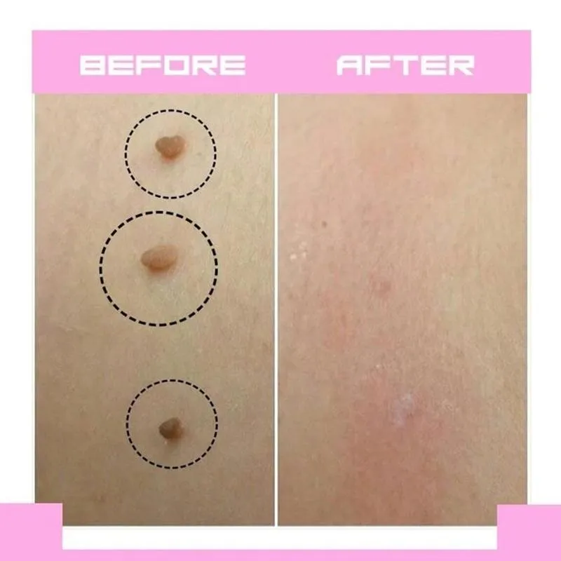 

1pc Skin Tags Remover Metal Clip Blackhead Skin Blemish Acne Pimple Removal Tag Out Beauty Tools Spot Tip Wart Removal Clips