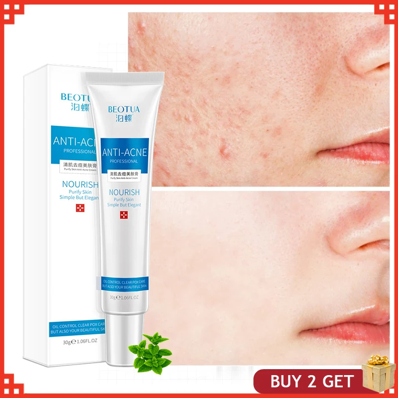 

30g Plant Extraction Acne Treatment Cream Collagen Removal Anti Acne Whitening Shrink Pores Face Care Oil Control Skin Care