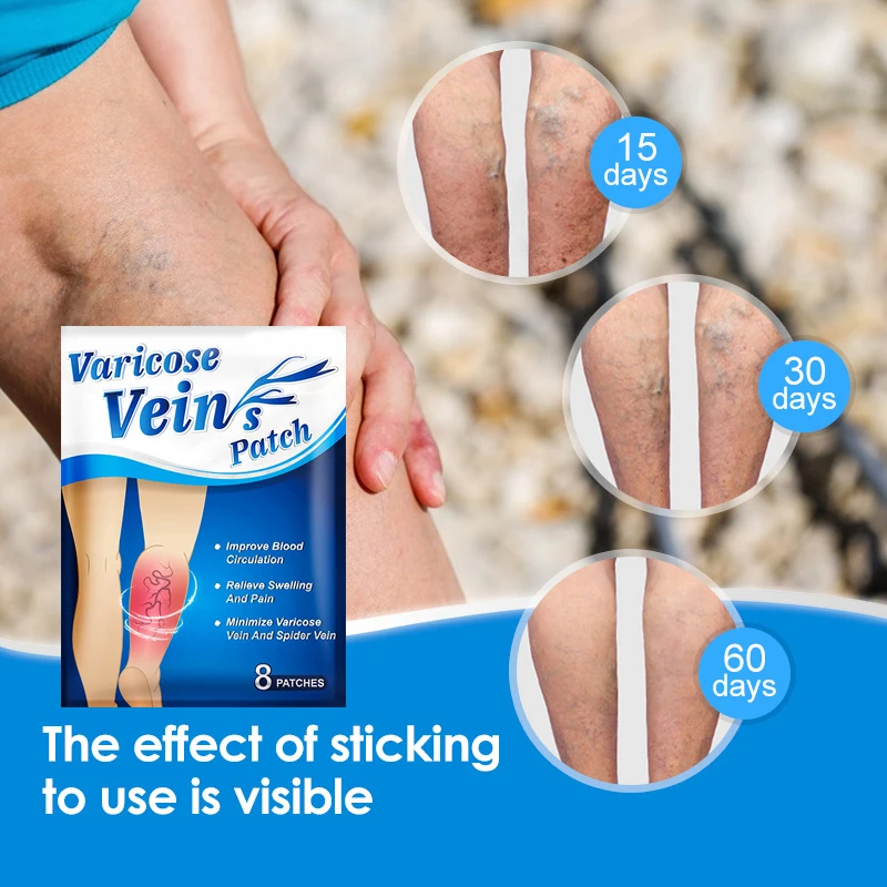 

2021 Varicose Veins Patch Relief Phlebitis Angiitis Remedy Pain Relief Patch for Spider Veins Edema Nerve Pain Leg Pain
