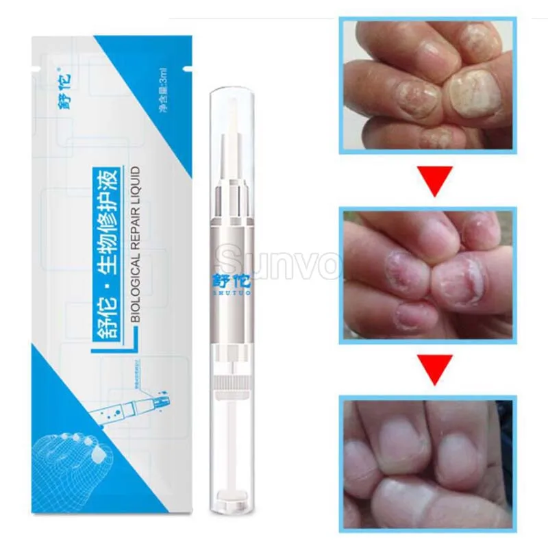 Крем для лечения Ногтей от грибков эссенция трав онихомикоза паронихии