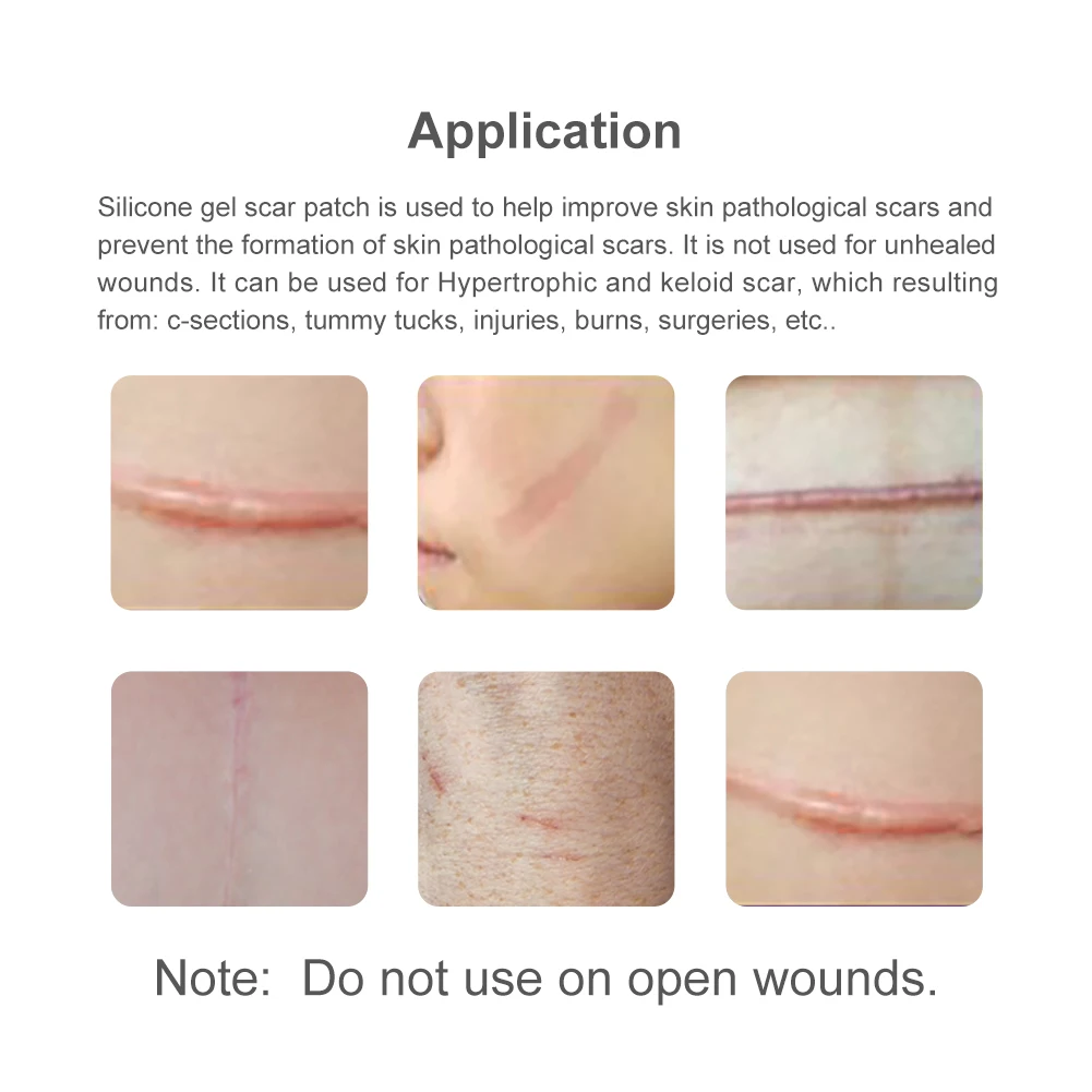 

Winner Silicone Scar Repair Sheet Soft Reusable Silicone Scar Strips Sticker for Scars Waterproof Band Aid for Outdoor Camping