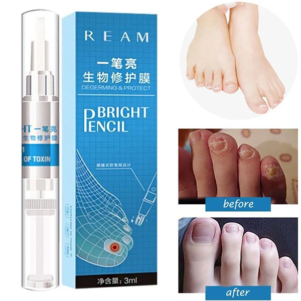

3ml Nail Fungus Treatment Liquid Toenail Anti Fungal Nails Care J9