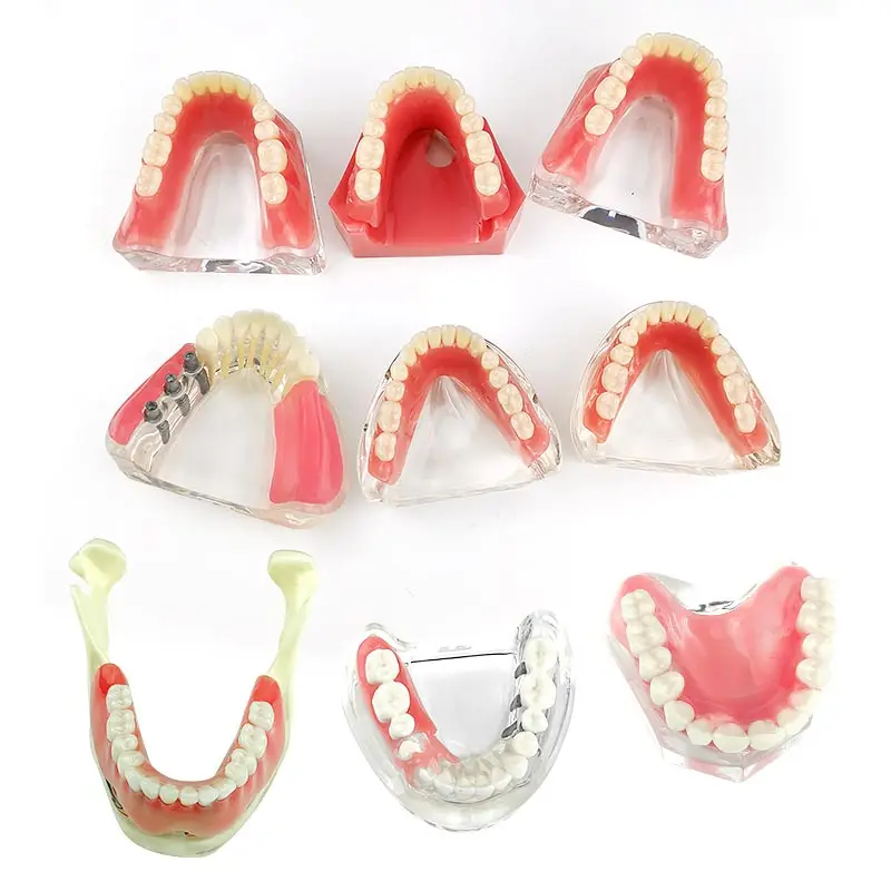 

Dental Teeth Model Removable Interior Mandibular Demo Overdenture with Implants Upper/Lower for Teaching Study