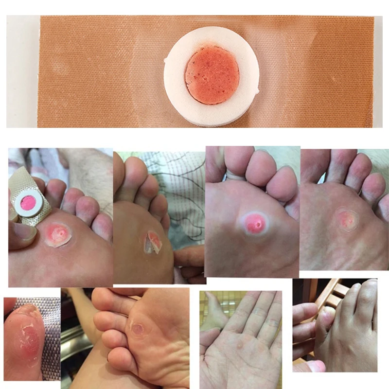 30pcs Foot Health Care Plaster Corn Removal Calluses Plantar Warts Thorn Pain Relief Pads Patches TSLM1 | Спорт и развлечения