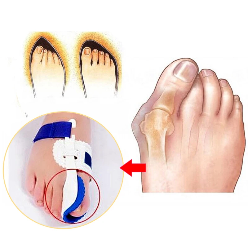 1 пара = 2 шт. ортопедические ремешки для ног | Красота и здоровье