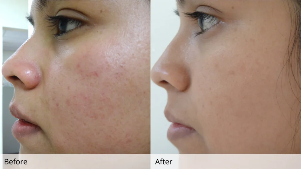 

1 box / 2 boxes-Gel 5% Galderma Anti Acne Spots Pimples 15g/box