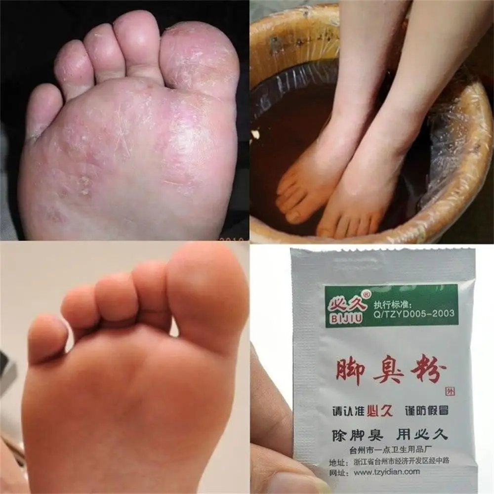 10 шт. антиперспирант для ног от псориаза | Красота и здоровье