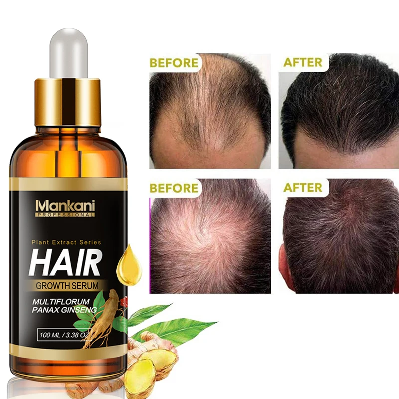 

Mino 5% Mankani 100mL Natural Herbal Essential Hair Growth Oil Ginger Regrowth Hair serum Organic Hair Loss Treatment Unisex