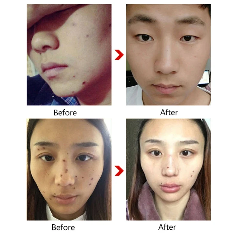 Rose Essential Oil Nourishing Skin Removing Nevus Freckles Facial Lighten Whitening Face Serum | Красота и здоровье