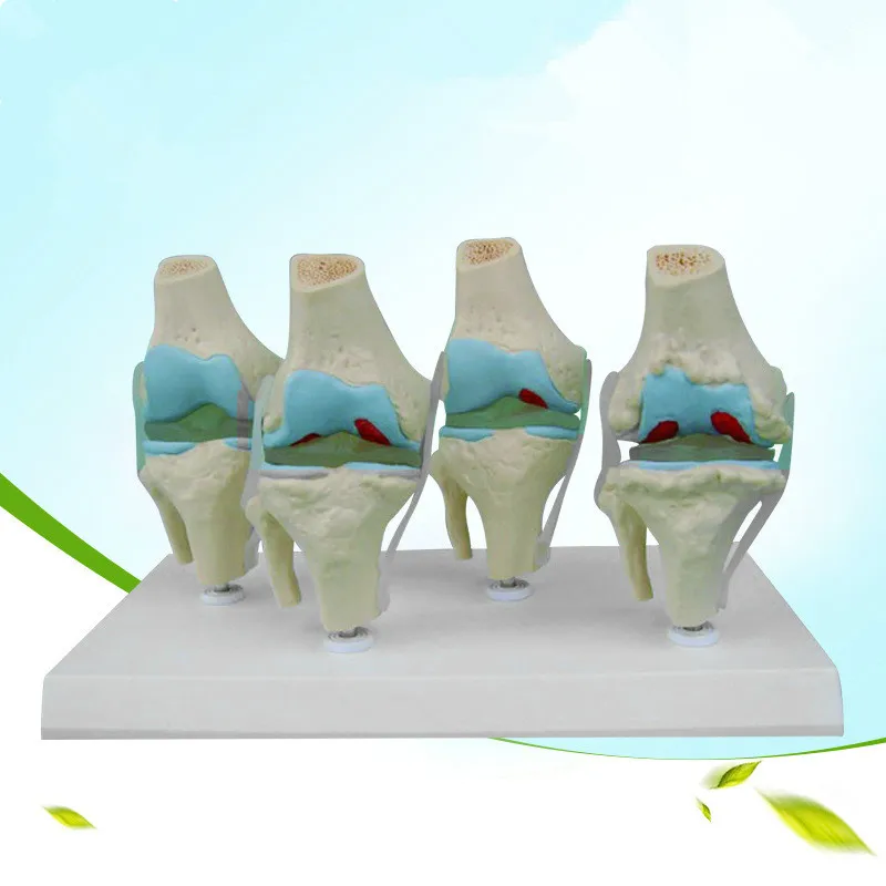 Анатомический человеческий дегенеративный коленный сустав болезни Скелет Череп