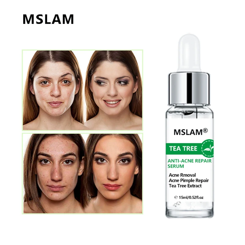 

MSLAM Tea Tree Anti Acne Serum Repair Acne Pimple Removal Fade Acne Mark Remove Acne Scar Treatment Shrink Pores Face Skin Care