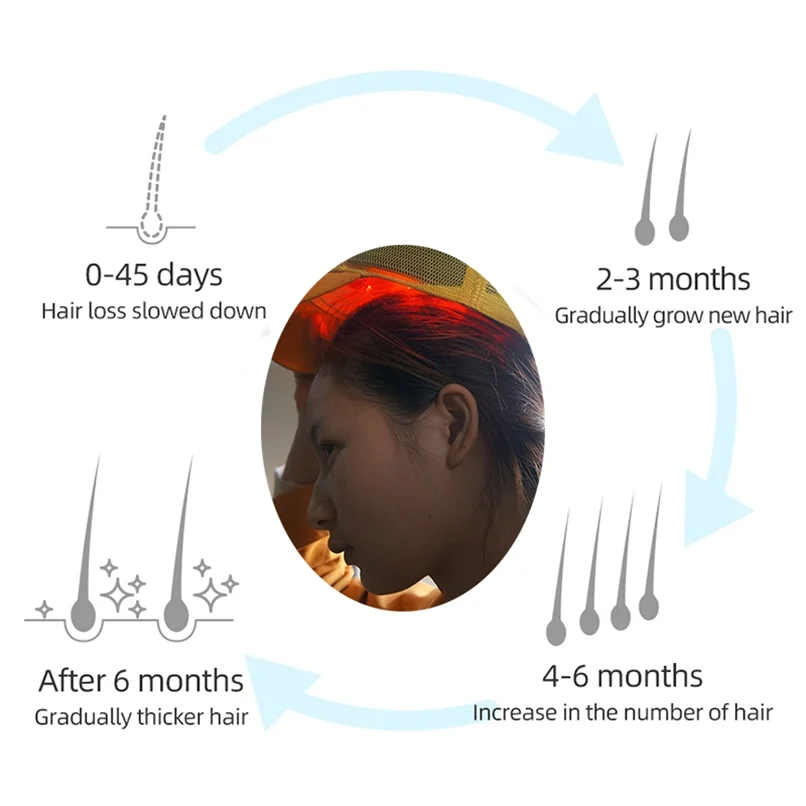 

Upgrate Hair Regrow Laser Helmet 96 Medical Diodes Treatment Fast Growth Cap Hair Loss Solution Hair Regrowth Machine