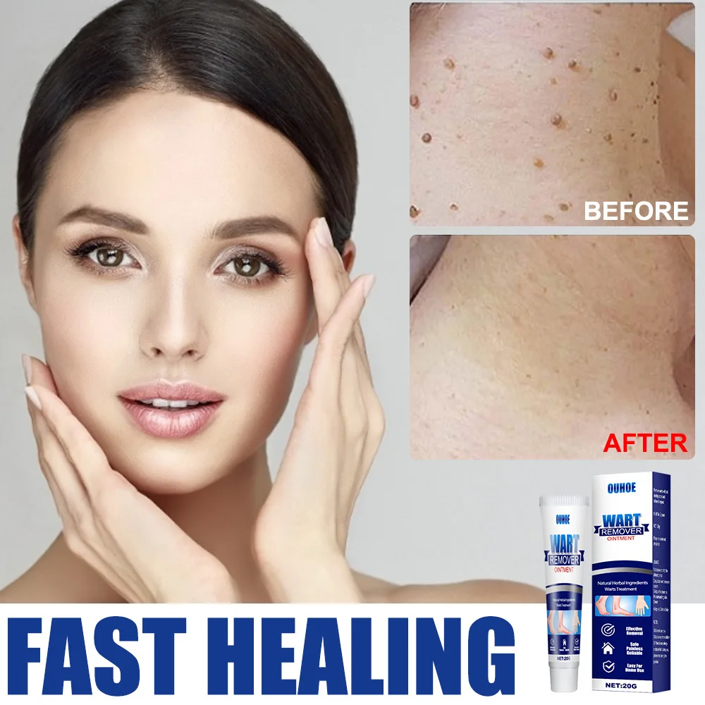 

Мазь для удаления бородавок, крем для лечения бородавок, бирка для кожи шеи, бирка для удаления бородавок, плоских бородавок, корней, травяно...