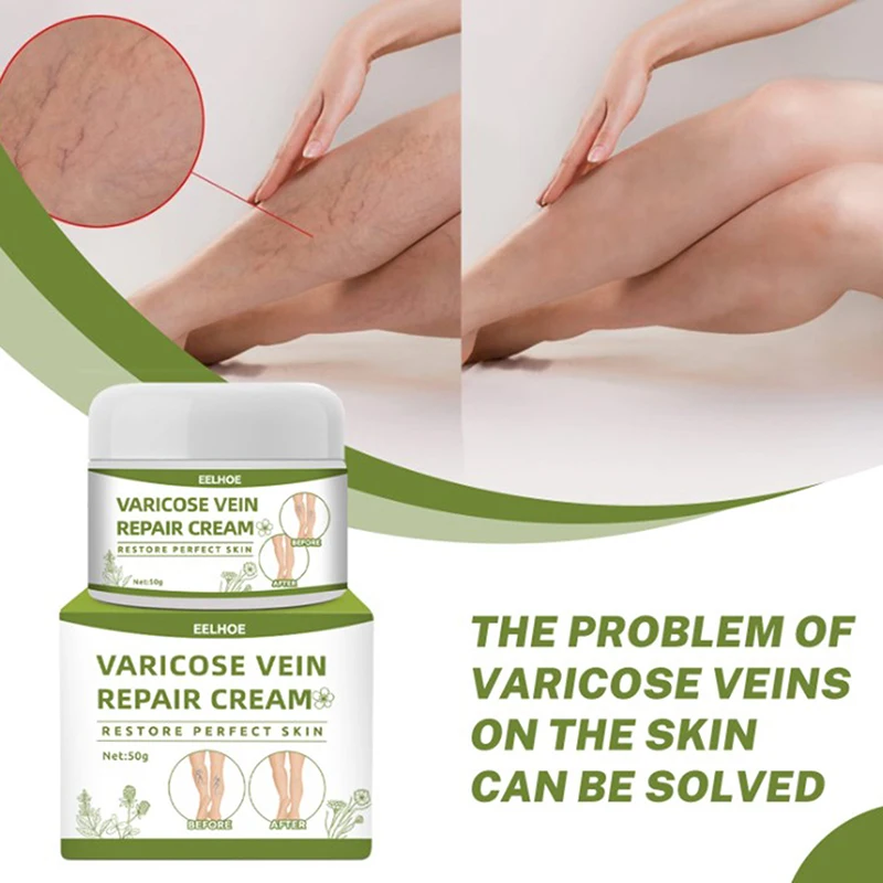 

Натуральный Крем для лечения варикозного расширения вен и пауков, китайская травяная медицина, удаление вен пауком