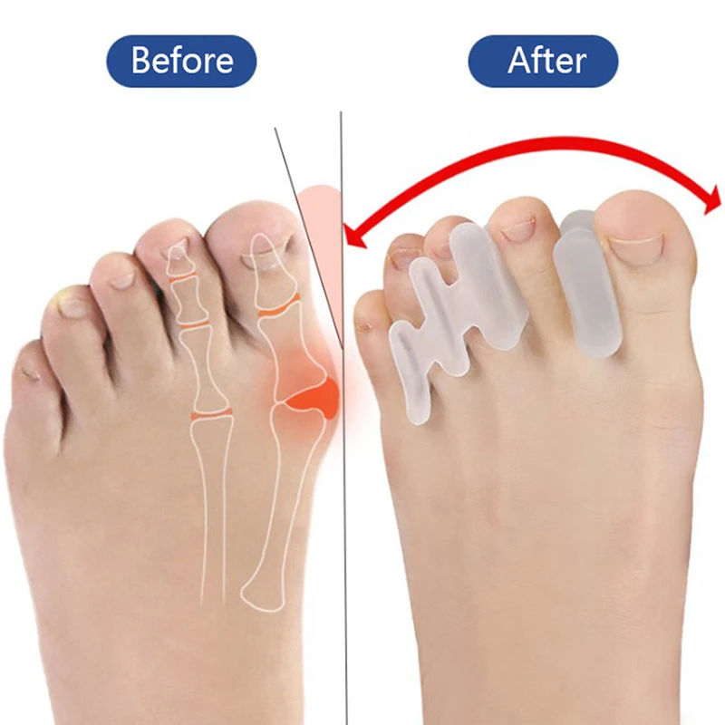 1 пара корректоров Силиконовая защита для пальцев большого пальца от волдырей