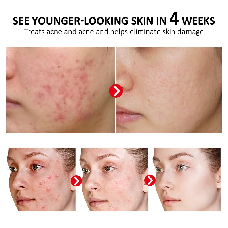 

Cleaning Acne Skin Antibacterial Acne Healing Cream Gel Scar Removal Skin Repair Cream Comedone Pimple Blackhead Treatment