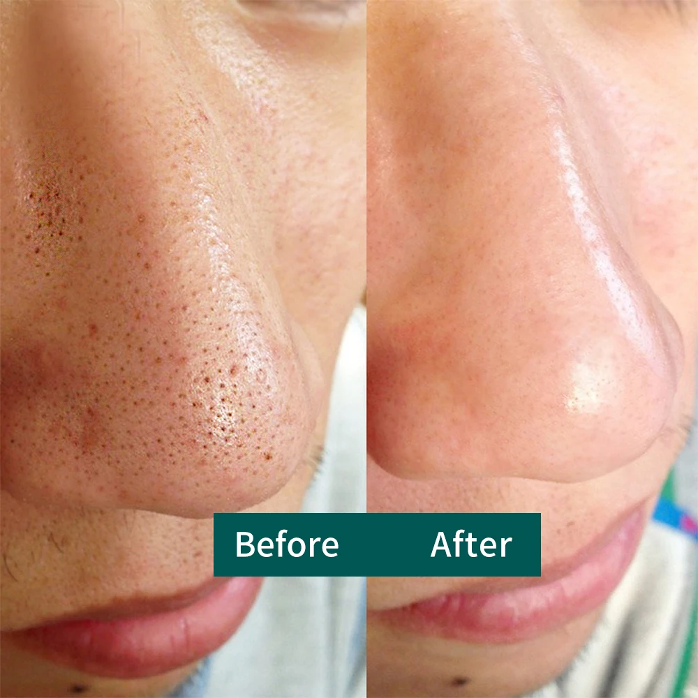 Acne, pustular acne, acne vulgaris special effect anti-inflammatory acne gel 25gm