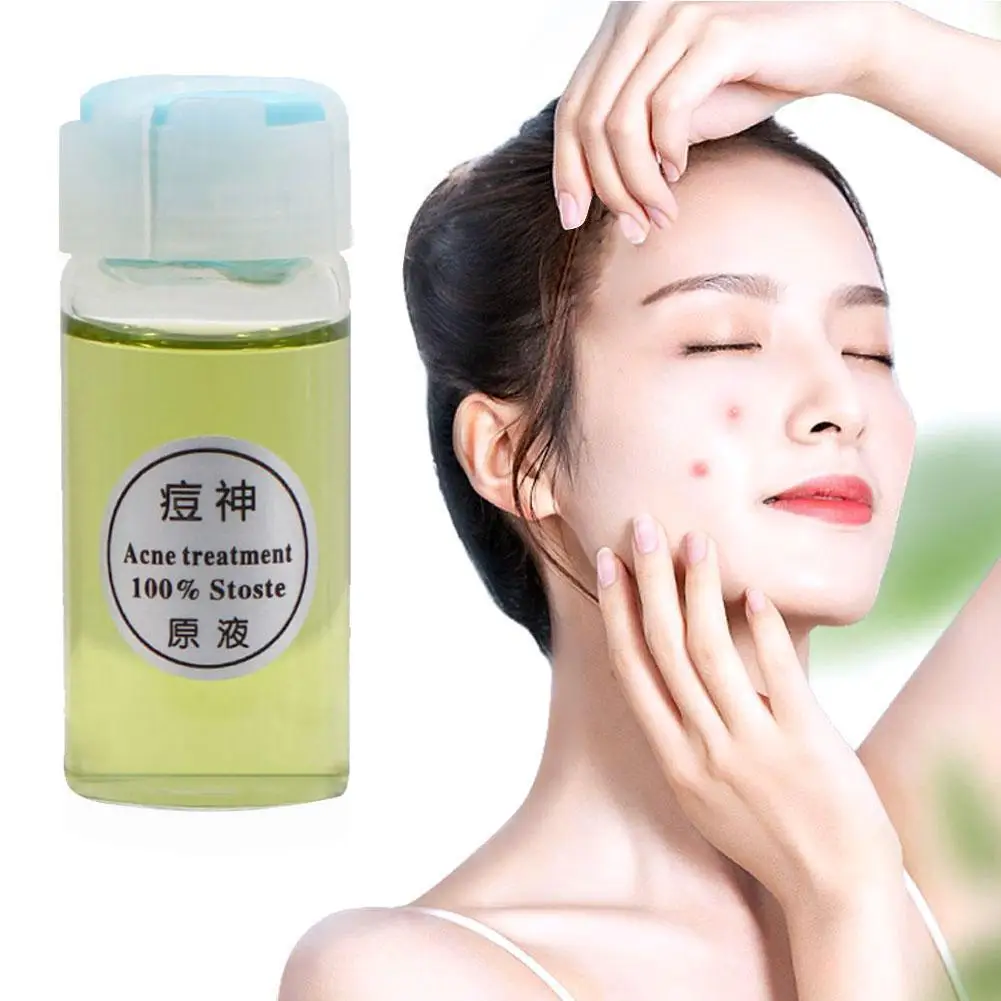 

Herbals Acne N Pimple Face Oil Cream Spots BlackHead Removing Acne Serum Blemish Peeling Treatment Makeup Solution Face A0J5