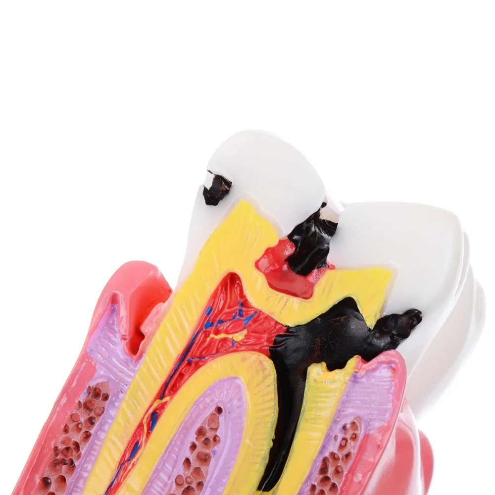 1 шт. стоматологическая анатомия модель зубов 6 раз сравнение кариеса учебные