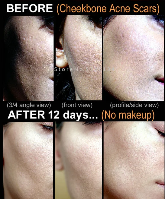 

Indented Acne Scar Removal Peel Chicken Pox Ice Pick Rolling Boxcar Scars Acne Cream