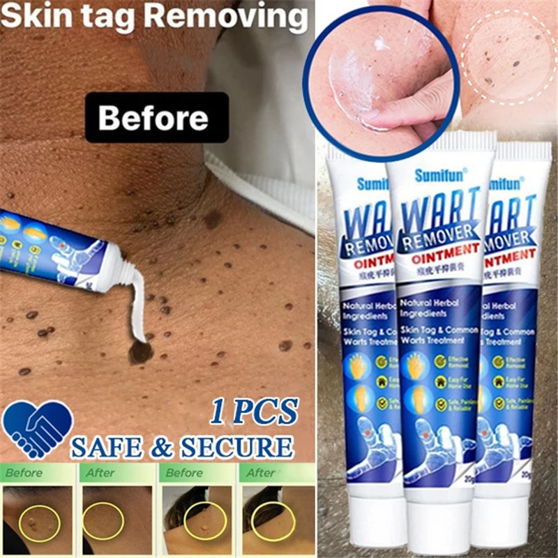 Sumifun Wart Remover Skin Tag Ointment 12 hours Tu kill Medical Mole &ampamp Genital | Красота и здоровье