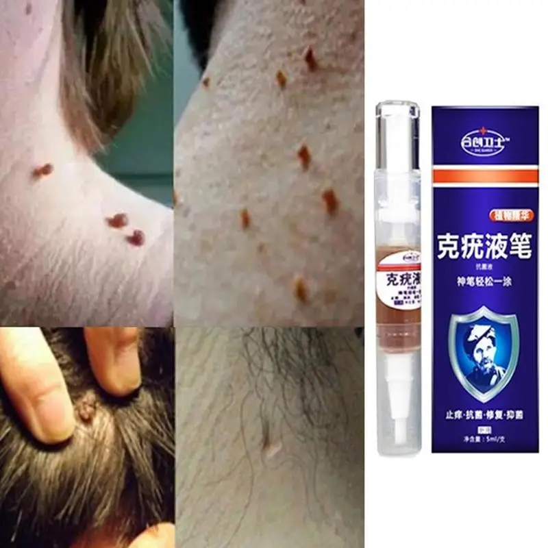 Средство для удаления мозолей на ногах сверхпрочное средство бородавок 12 часов 5