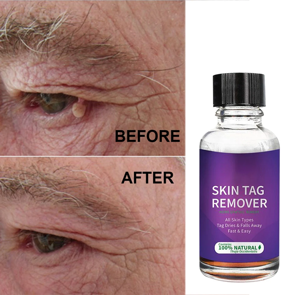 

30ml Wart Mole Removal Serum Effective Fast Acting And Safe Treatment Skin Tag Wart Mole Remover Strength Skin Tag Treatment