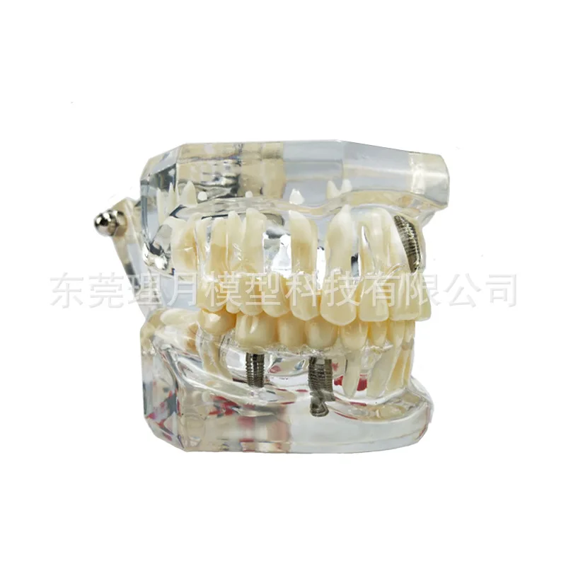Смоляная съемная модель зубов стоматологическая передвижная патологическая