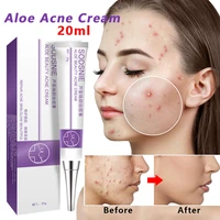 anti acne cream oil control face skin care repair comedone pimple natural herbal remove scar gel treatment remover facial 20g