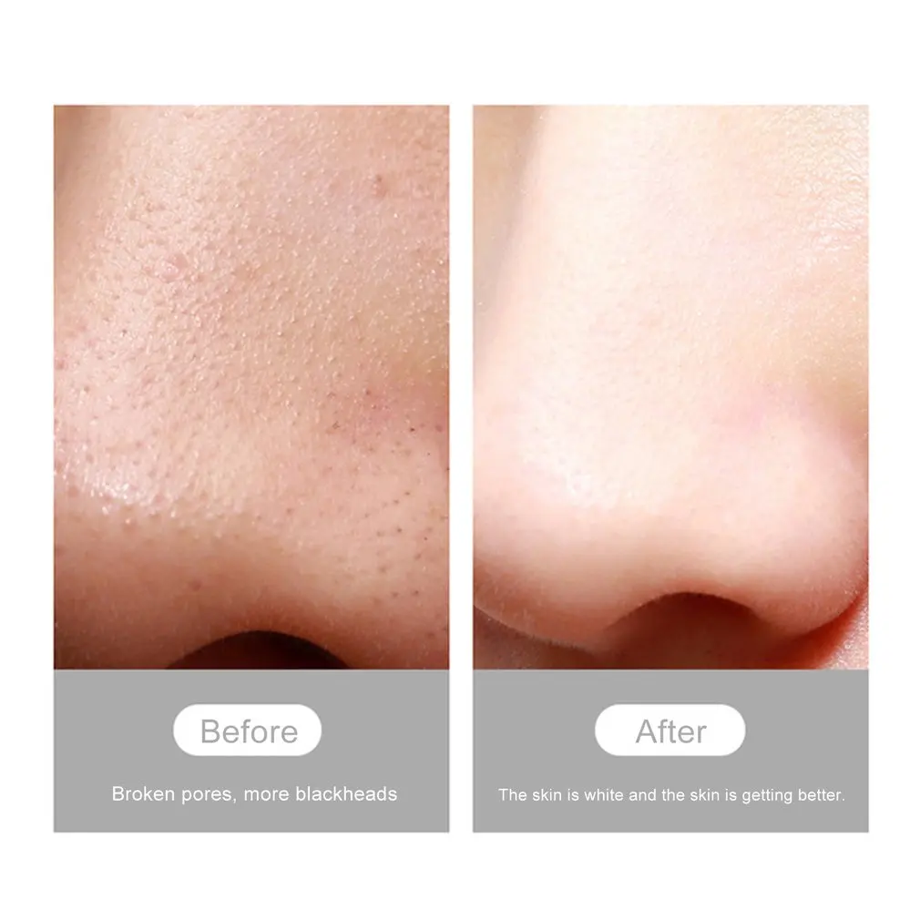 USB перезаряжаемая визуальная угревая камера для удаления пор лица с Черной