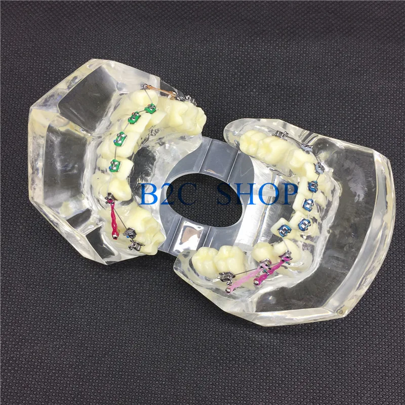 Стоматологическая Ортодонтическая модель с красочными кронштейнами для