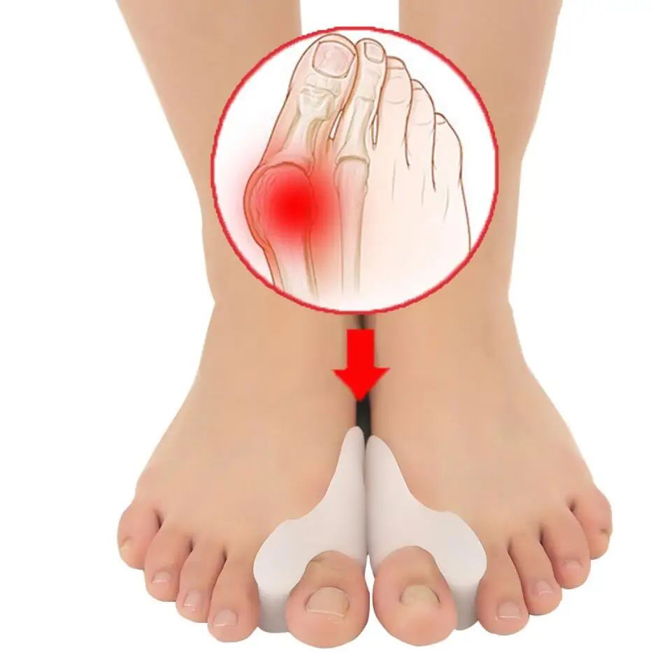 2 шт. силиконовый разделитель для пальцев ног при вальгусной деформации|protector