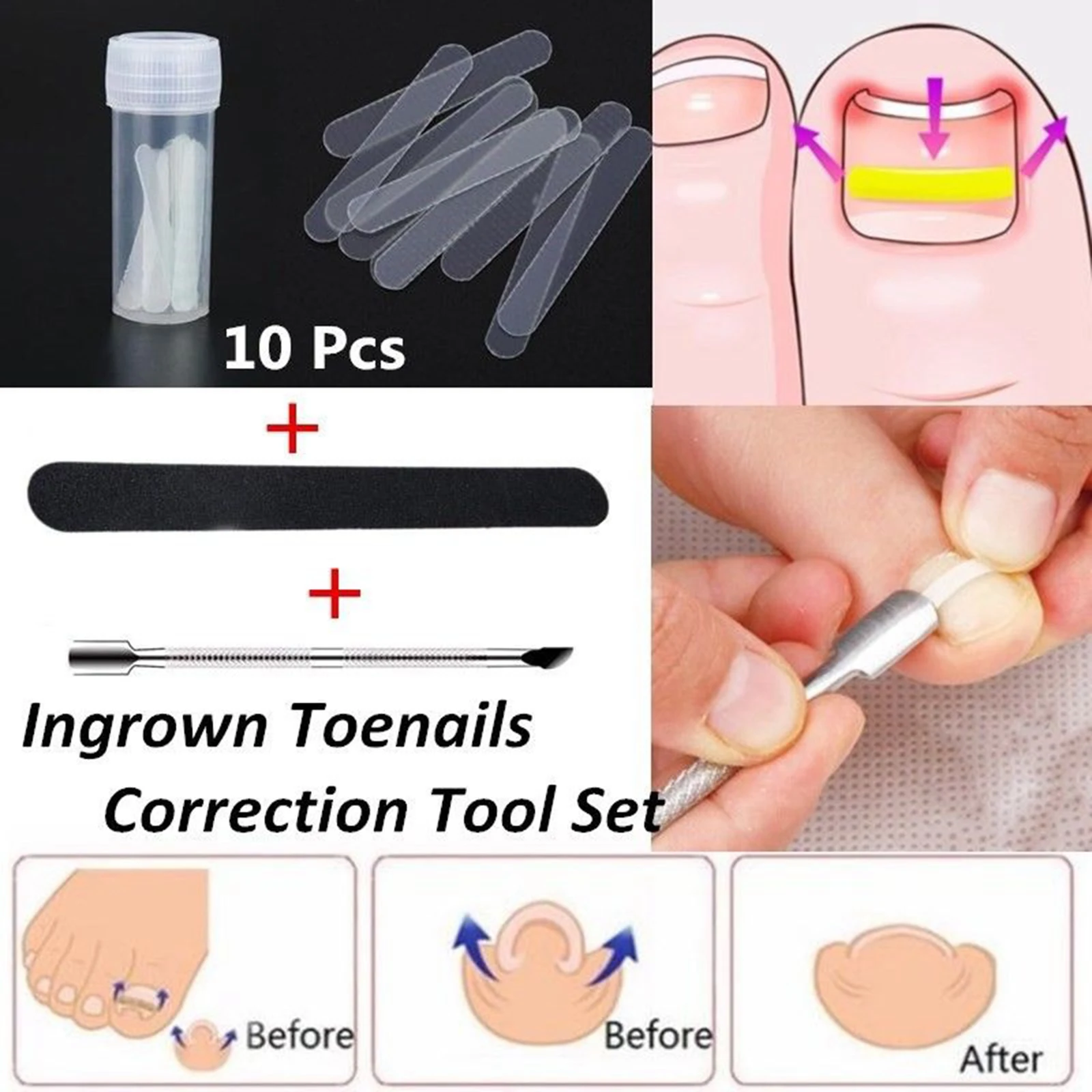 

Professional Pedicure Ingrown Toenail Straightening Clip Bracket Toe Nail
