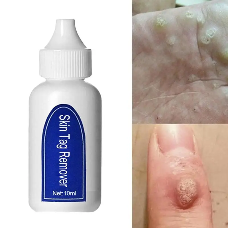 

1Pcs Wart Treatment Papillomas Removal Of Warts Liquid From Skin Tags Removing Against Moles Remover Skin Remedy Beauty Supplies