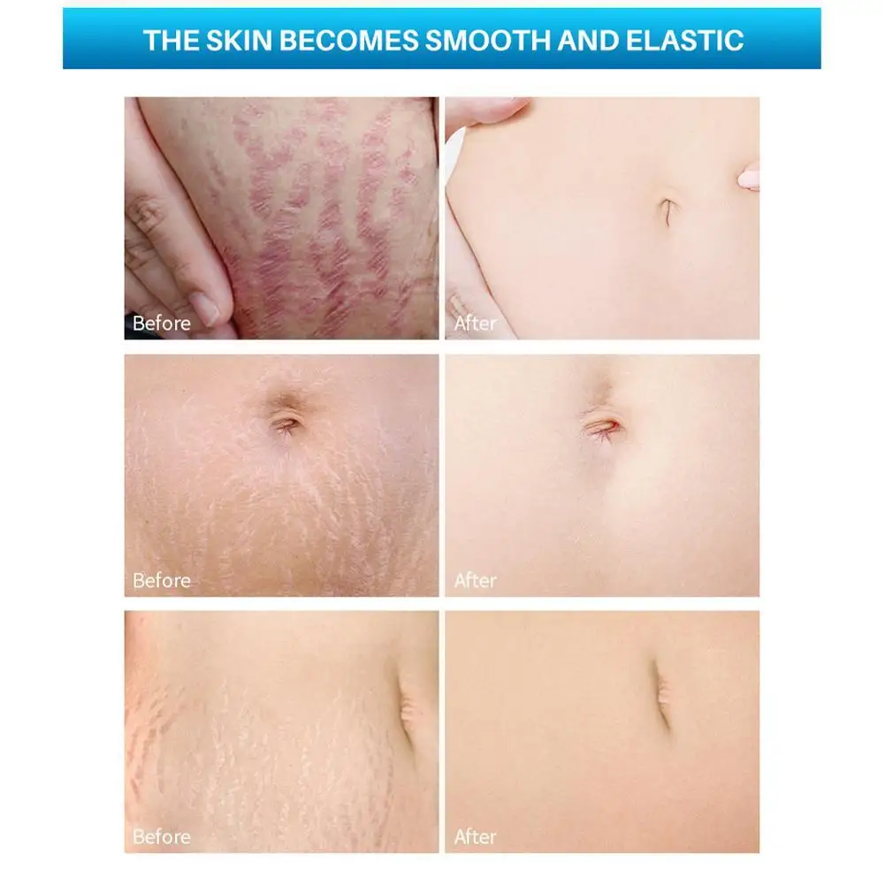 Антивозрастная эссенция для удаления морщин и растяжек делает кожу гладкой