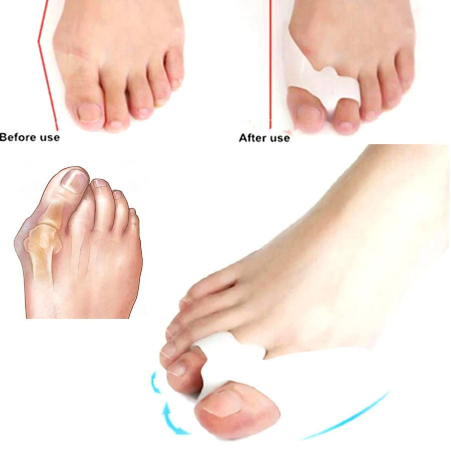 Инструменты для педикюра и ногтей 2 кольца разделитель пальцев ног растяжки