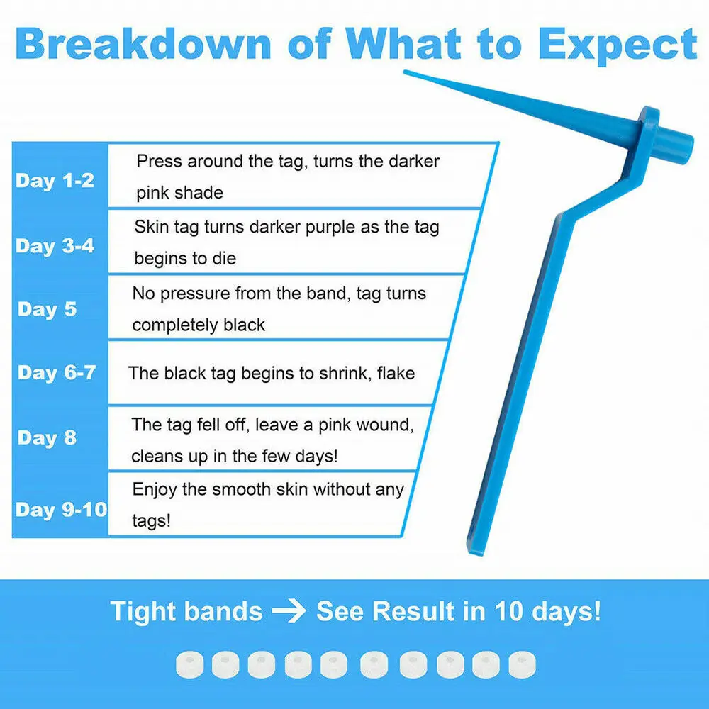 

Micro Skin Tag Remover Device Kit For Small To Medium Skin Tags Removal Tool