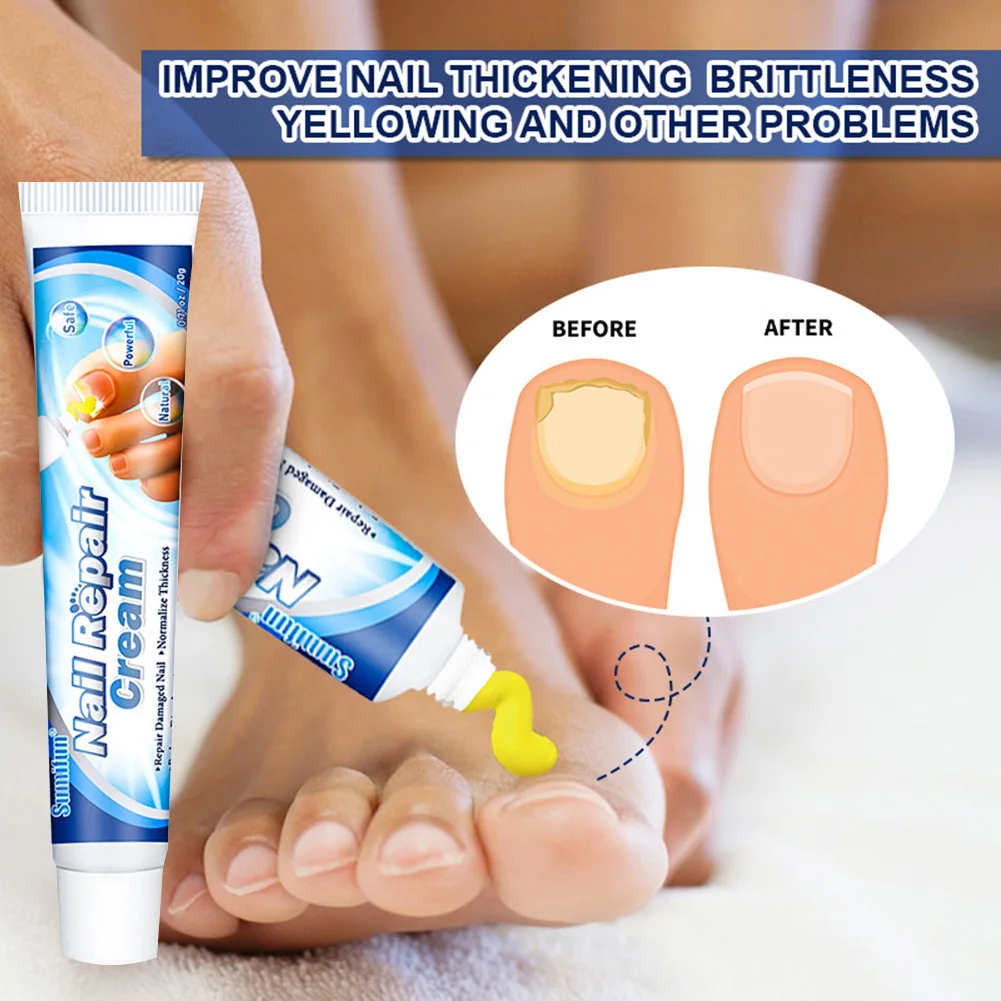 

Fungal Nail Treatment Cream Nail Repair Ointment Infection Toenails Care Promote New Growth Fungal Removal Cream