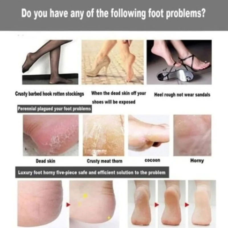 Набор для разминания ног шлифовальный артефакт отшелушивания мозолей после