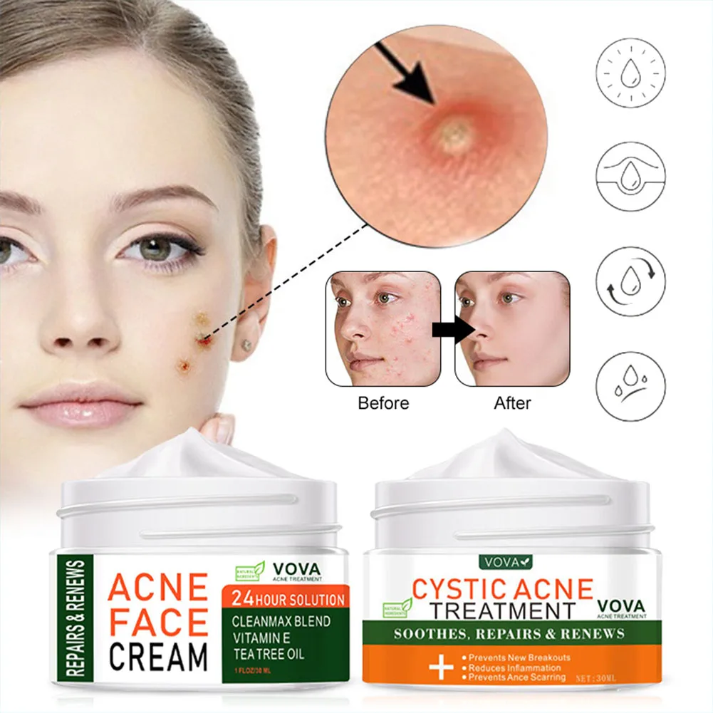

Acne Treatment Cream Face Skin Repair Cream Safe Smooth Acnes Spots Pimples No Irritation Skin Acne Remover Cream For All Skins