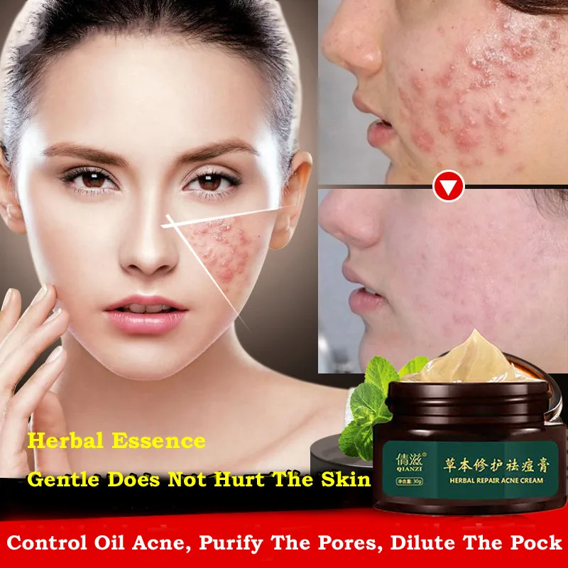 

Herbal Acne Cream Anti Pimple Spot Acne Scars Blackhead Removal Cream Whitening Beauty Skin Face Care Creams Acne Treament