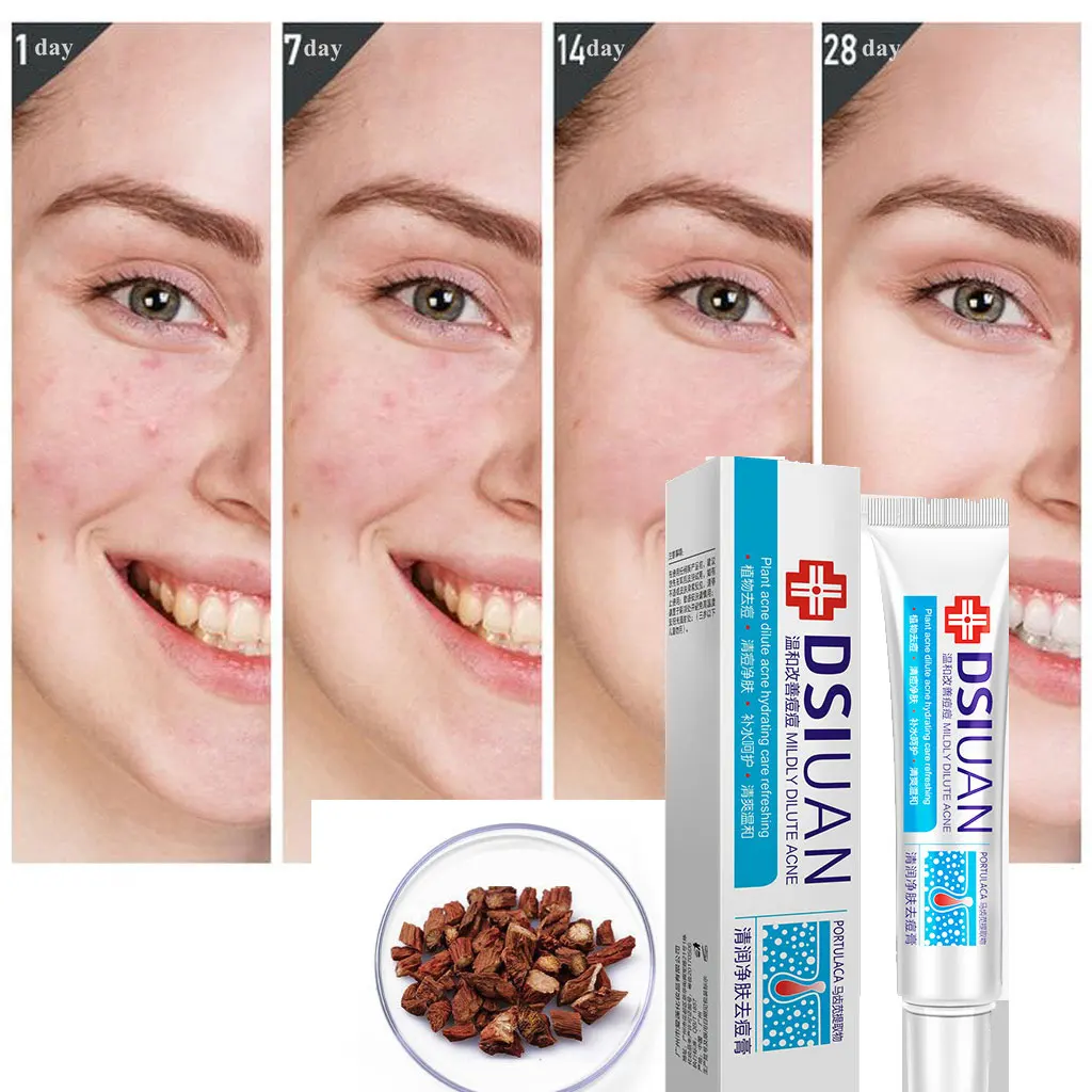 

Herbal Effective Acne Remover Cream Natural Plant Acne Treatment Fade Acne Spots Acne Cream Oil Control Shrink Pores Skin Care