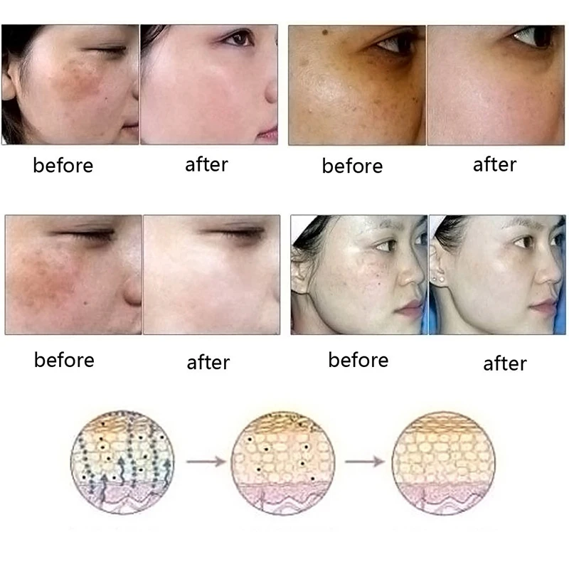 Natural Essential Ultra Brightening Spotless Oil Skin Care Dark Spots Remove Acne Burn Scar Removal Whitening Essence |